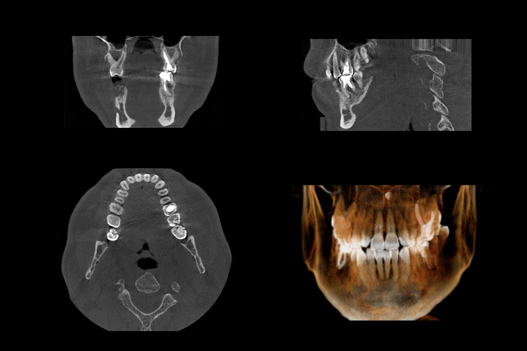 3D Cone Beam Imaging Bellevue, WA Bellevue Dental Studio
